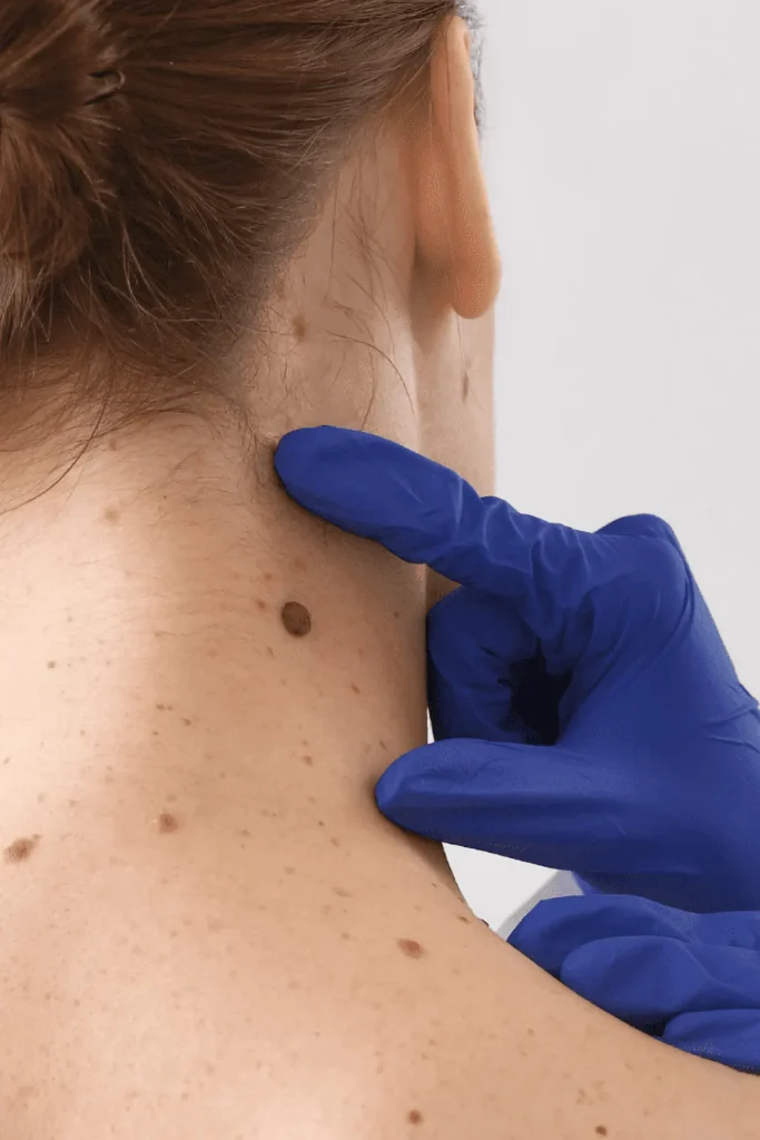 Mole Removal | Skin Clinic in Rajkot | opalclinics