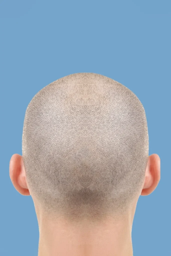 Scalp Micro pigmentation | Hair Clinic in Rajkot | opalclinics